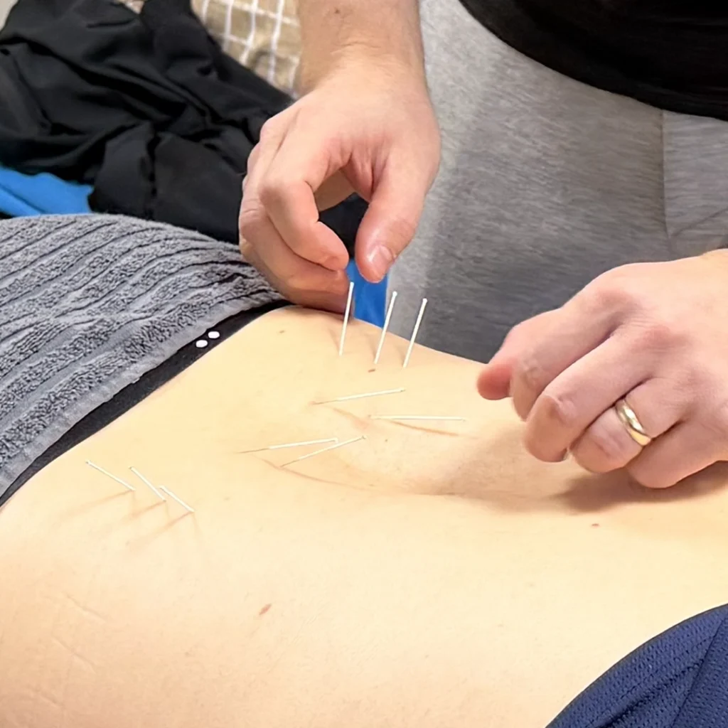 Akupunktio Seinäjoella